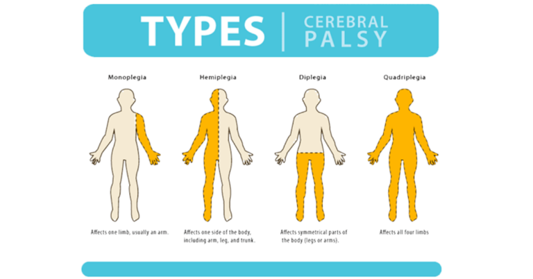 Cerebral Palsy Stem Cell Treatment in India: A Comprehensive Overview